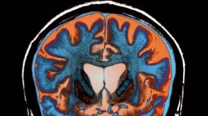 Huntington's disease: excitement as trial shows drug could slow down progression