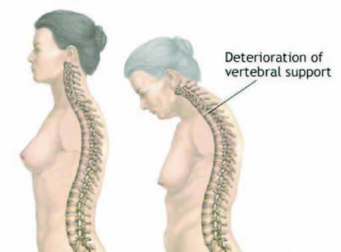 Osteoporosis: The silent bone eater