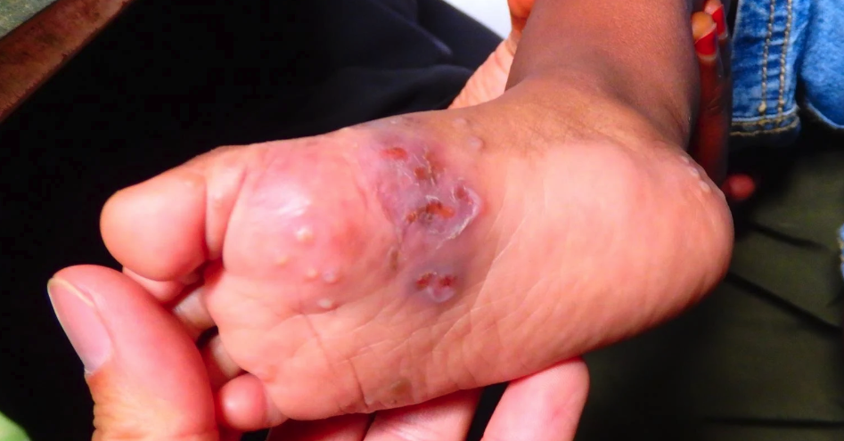 Scabies cases surged in 2023
