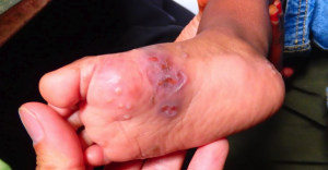 Scabies cases surged in 2023