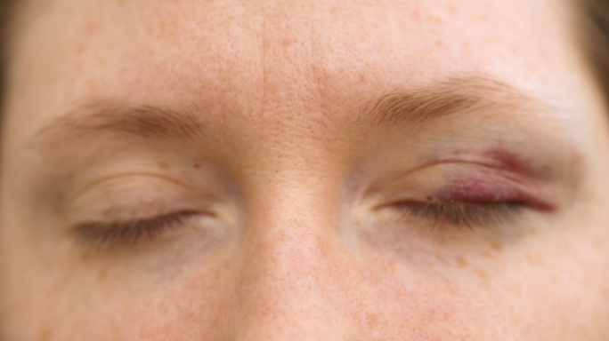 Accused denied bail after punching wife in the eye