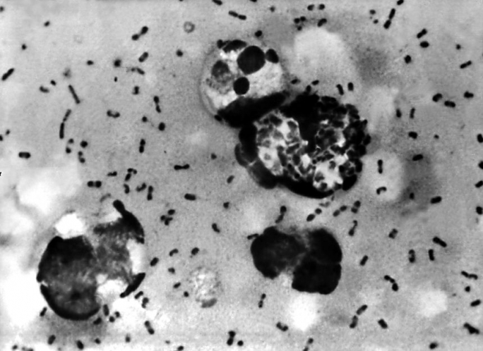 ECDC monitoring suspected pneumonic plague death in Russia, says no evidence of sustained transmission