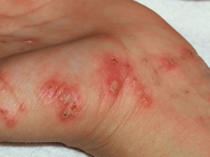 One case of scabies at St Paul's Bay school