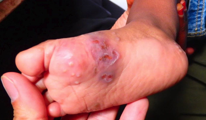 Scabies cases surged in 2023